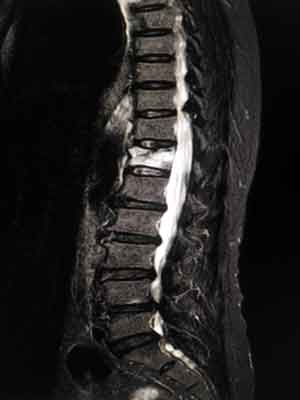 compression fracture melioguide physiotherapy ottawa