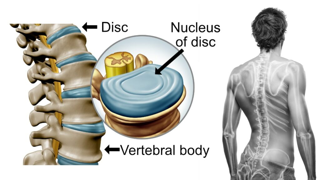 vertebral body, disc, disc nucleus