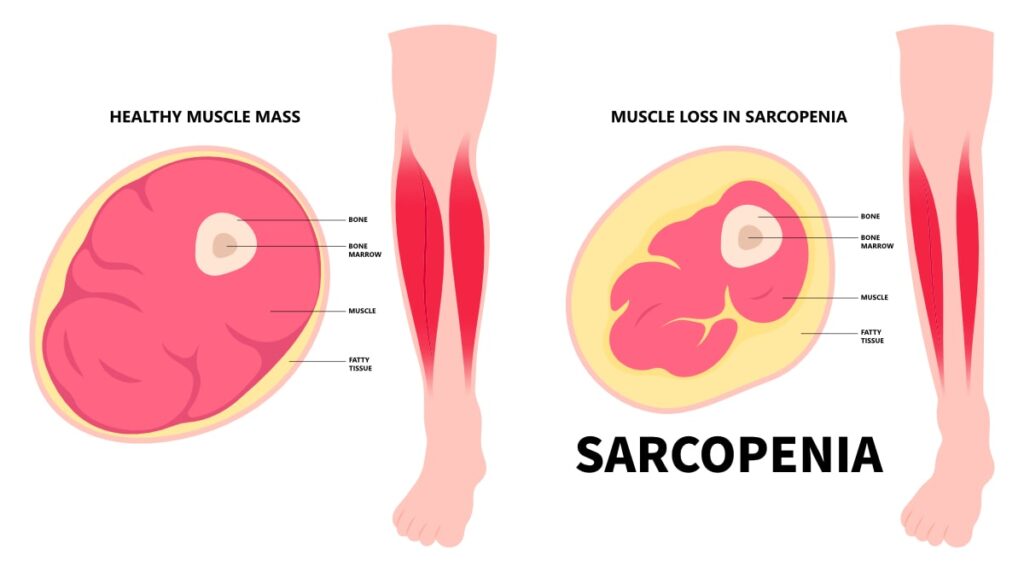 how to prevent sarcopenia