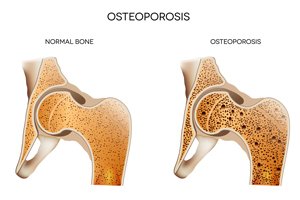 postmenopausal osteoporosis symptoms