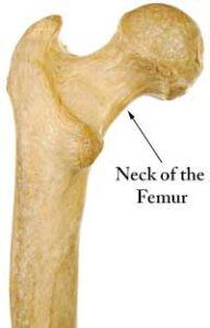 nek van femur | femurhals/femur nekfractuur