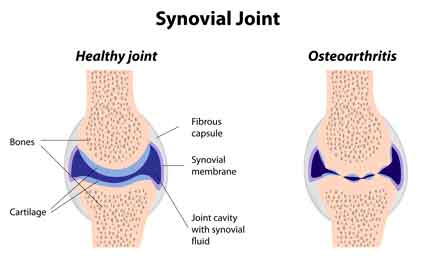 synovial joint hip and knee replacement therapy melioguide ottawa physiotherapy