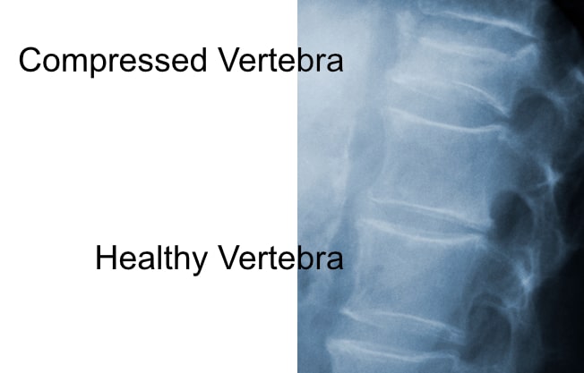 compressed vertebral body