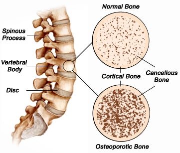 cortical and trabecular cancellous bone of the spine