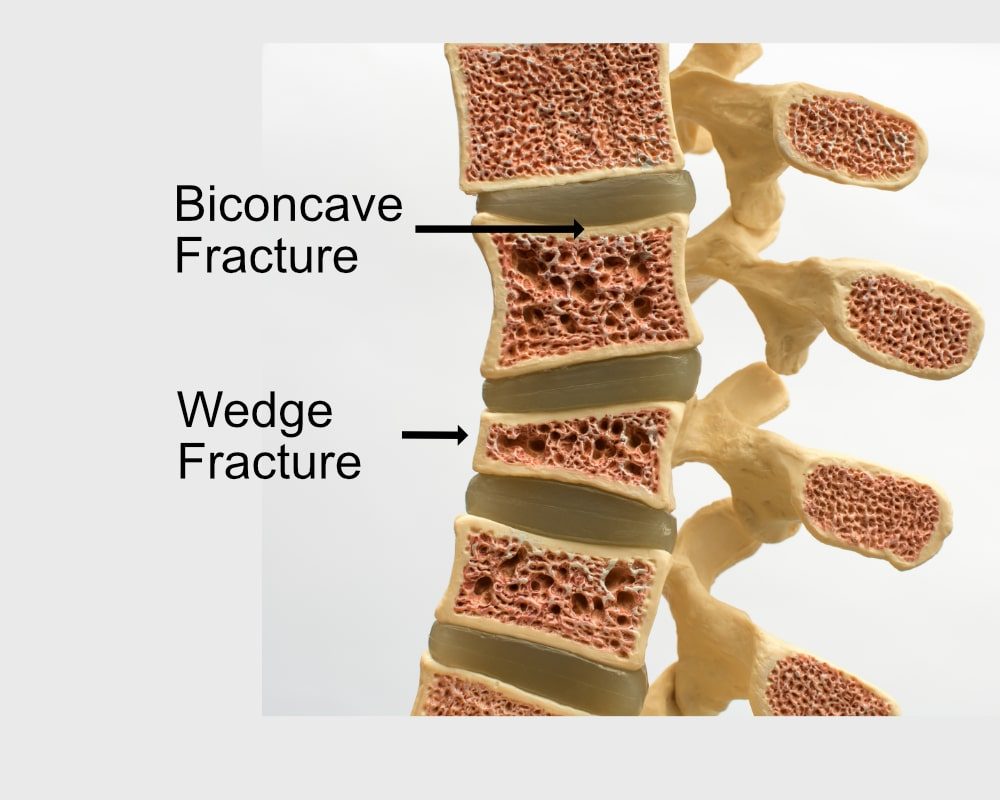 types of vertebral compression fractures picture