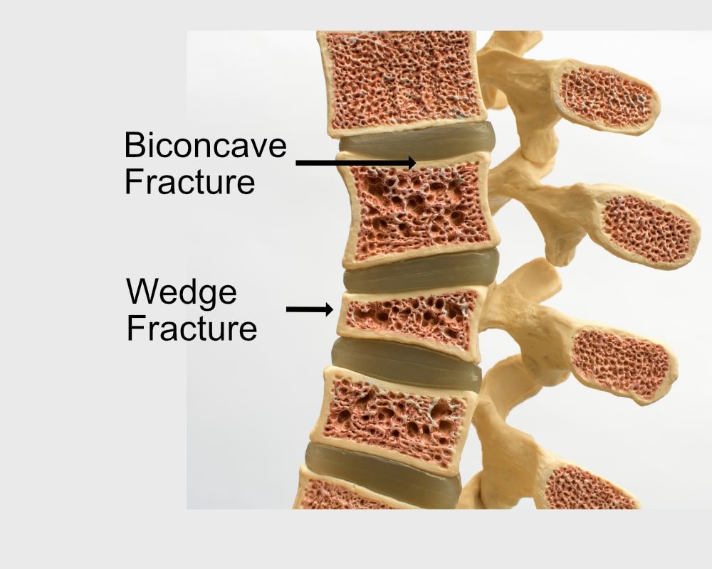 Compression Fracture Physical Therapy & Lumbar Exercises