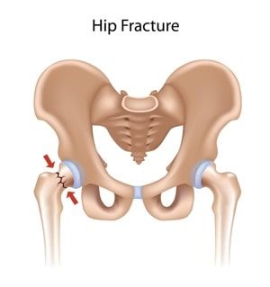 hip fracture osteporosis