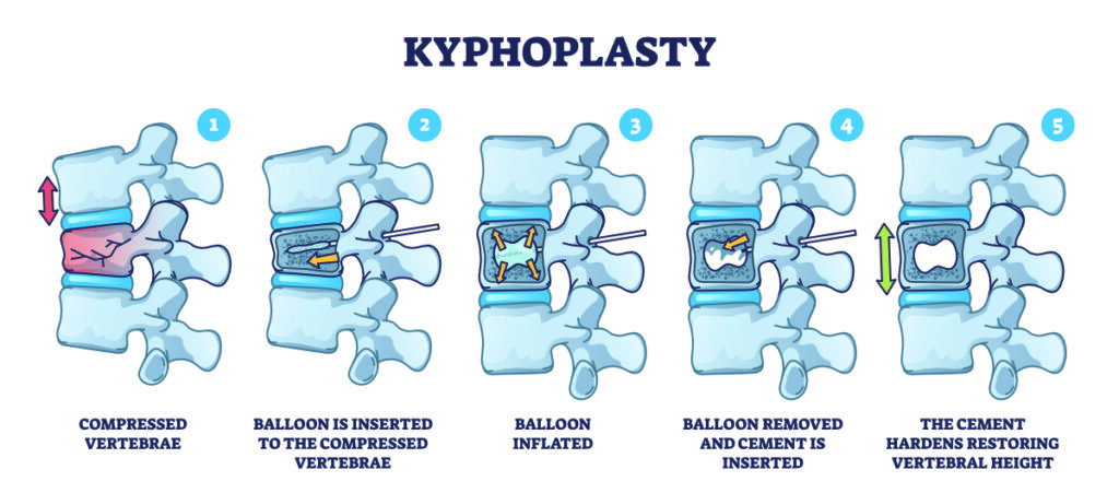 kyphoplasty steps for vertebral compression fractures