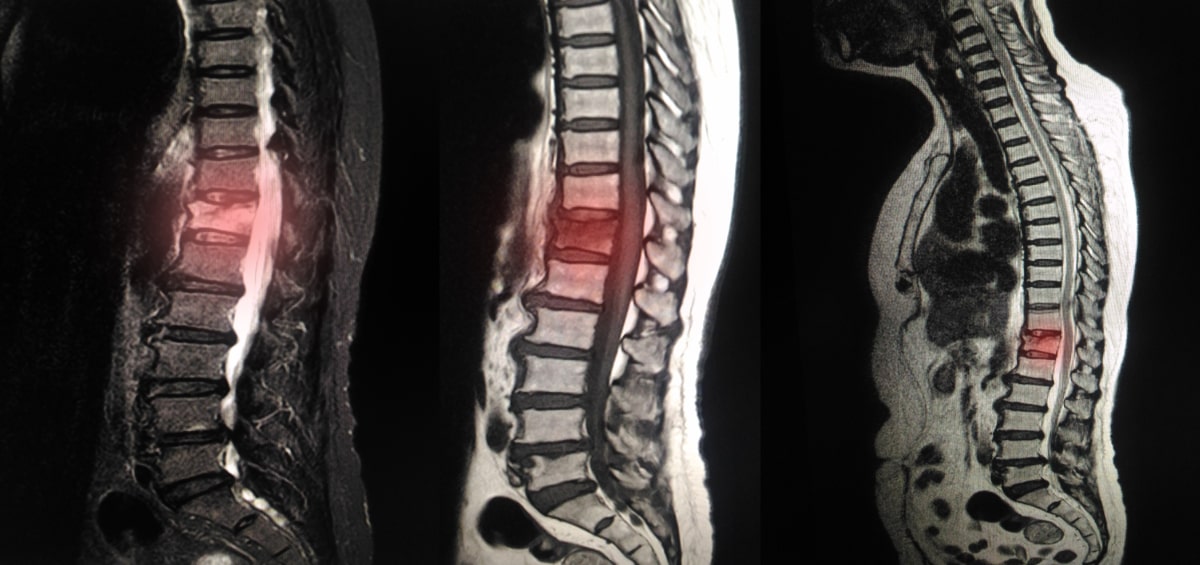 Can a Spinal Compression Fracture Heal on Its Own?