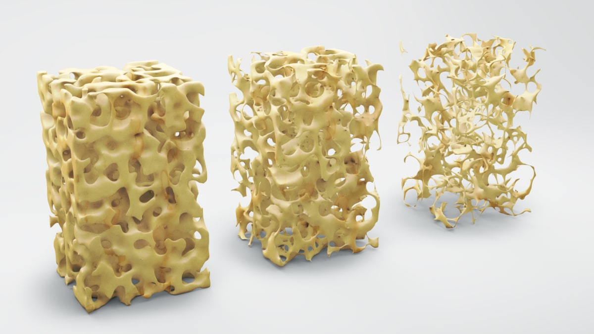 Bone Quality vs Bone Density Bone Fragility and Osteoporosis