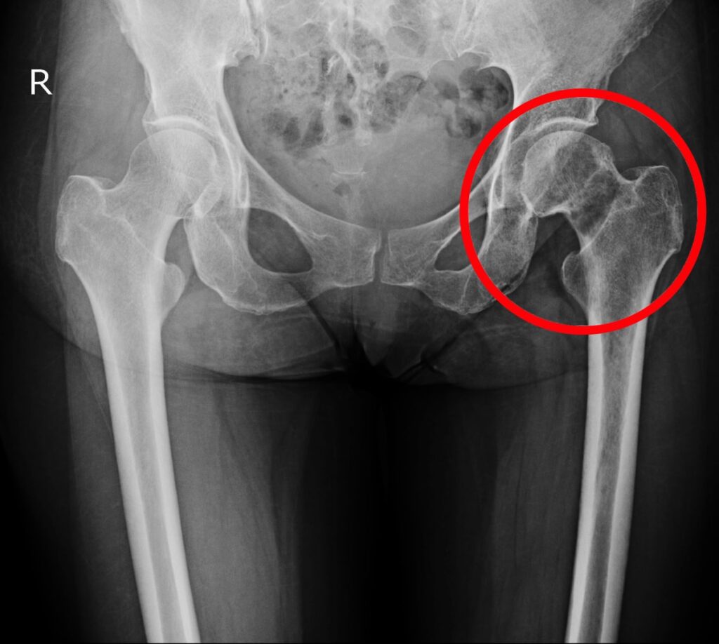 femoral neck fracture