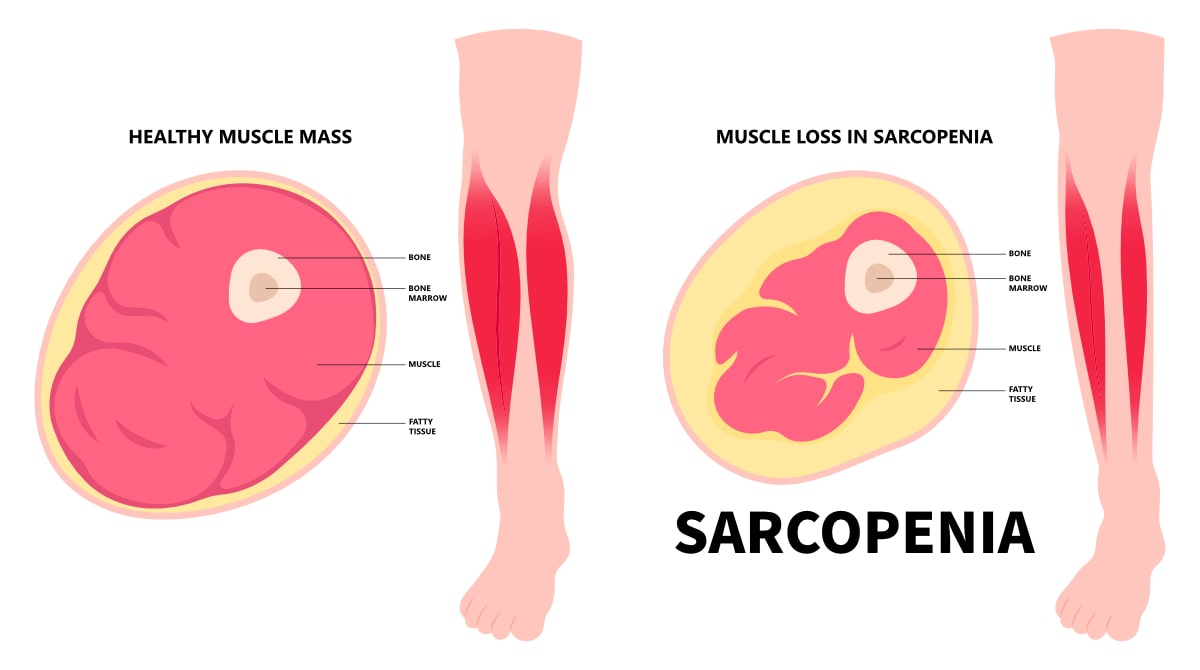 How to Prevent Sarcopenia and Muscle Loss