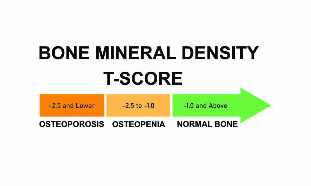 can you reverse osteopenia? | melioguide