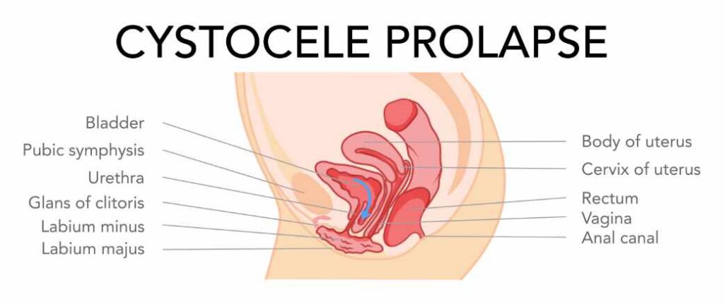 cystocele prolapse
