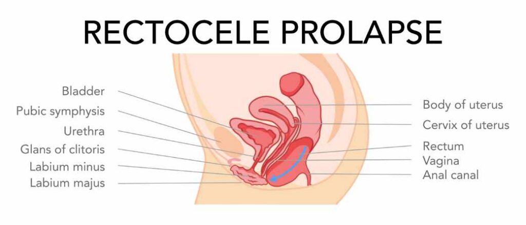 rectocele prolapse